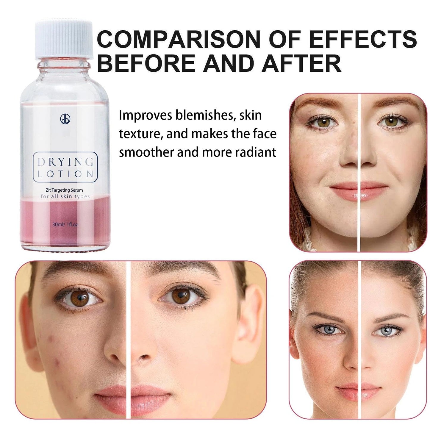 AuraAnge Zit - Targeting Serum - Face Serum for Blemish - Prone Skin, Helps Absorb Excess Oil, Suitable for Men and Women