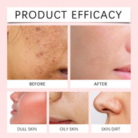 Xunzhi Acne Cream Pimple Cream for Face,Acne Treatment,Oil Control Pimple Remover Cr/eam,S/p/o/t Treatment,S/p/ot Crea/m,Acn/e Scar Treatm/ent,Anti Redness Crea/m for Face,Pim/ple Cre/am S/p/o/t Treatm/ent