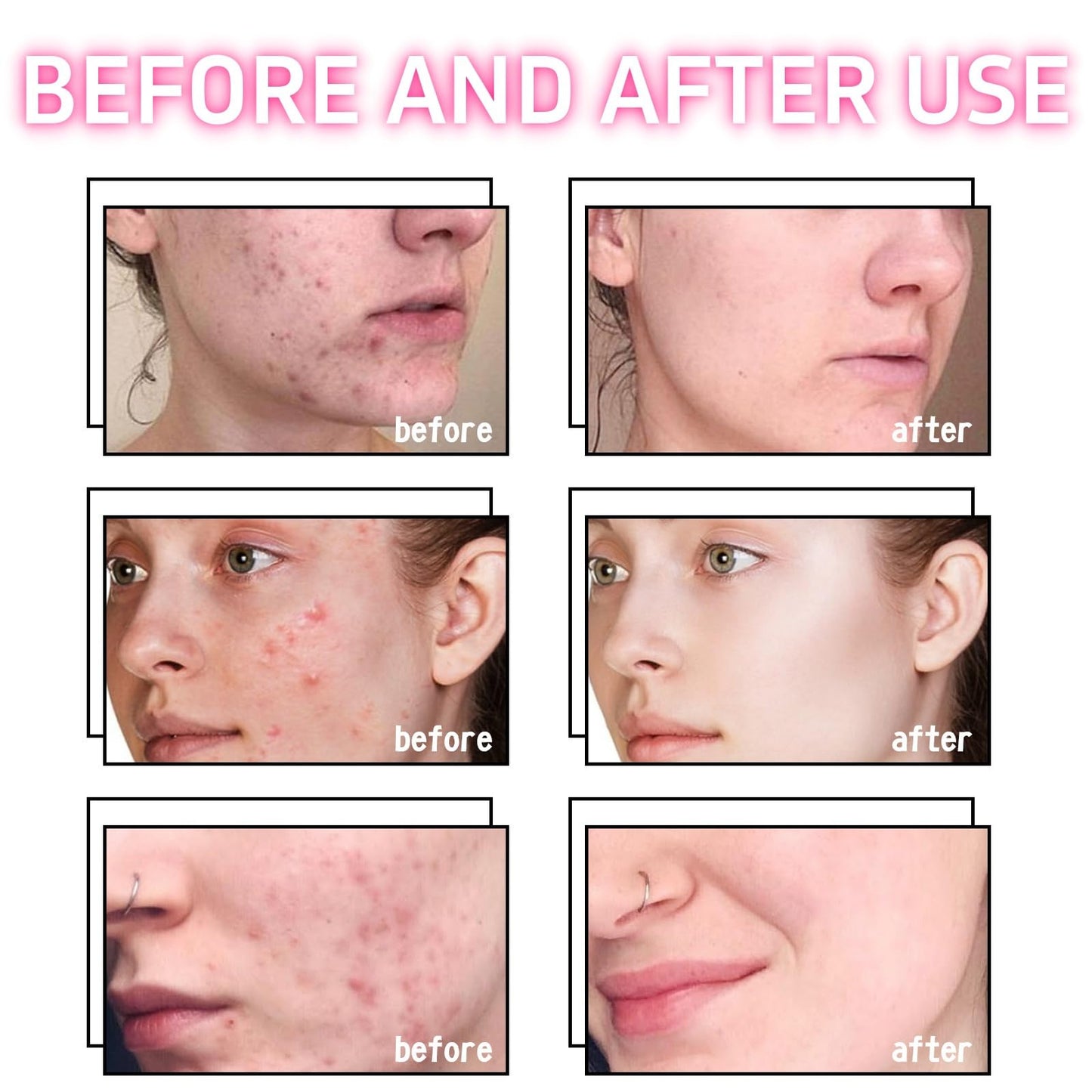 Xunzhi Acne Cream Pimple Cream for Face,Acne Treatment,Oil Control Pimple Remover Cr/eam,S/p/o/t Treatment,S/p/ot Crea/m,Acn/e Scar Treatm/ent,Anti Redness Crea/m for Face,Pim/ple Cre/am S/p/o/t Treatm/ent