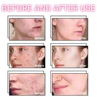 Xunzhi Acne Cream Pimple Cream for Face,Acne Treatment,Oil Control Pimple Remover Cr/eam,S/p/o/t Treatment,S/p/ot Crea/m,Acn/e Scar Treatm/ent,Anti Redness Crea/m for Face,Pim/ple Cre/am S/p/o/t Treatm/ent