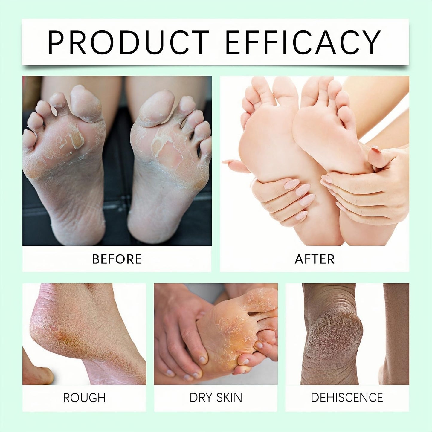 Jinjiar Urea Foot Cream,Urea Foot & Hand Cream for Dry Cracked,Cracked Heel Repair Cream,Fo-ot Cream for Cra-cked Heels and Dry Skin,Foot Moisturiser for Dry Cra-cked Feet,Fo-ot Peel,Fo-ot Care Products