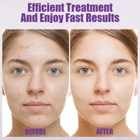 Azelaic Acid Cream, Azelaic Acid Face Serum Cream, Brightening Face Skin Care Treatment for All Skin Types, Repair Dark Spots for Fresher and Smoother Skin, (20g)