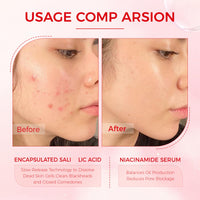 MEITREND Drying Lotion for Acne Treatment,Anti Acne Face Serum,Overnight Acne Drying Lotion,Spot Treatment,Pimple Lotio-n,Dry Out Blemishes & Pimple Reduce Redness