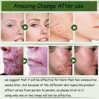Acne Cream,Moisturiser Face Cream Spot Cream Mens Moisturiser Tea Tree Cream Spot Cream For Acne Cream Moisturiser for Women Men Teenagers Dilute Face Prone Spot Marks Balance Facial Oil Cream