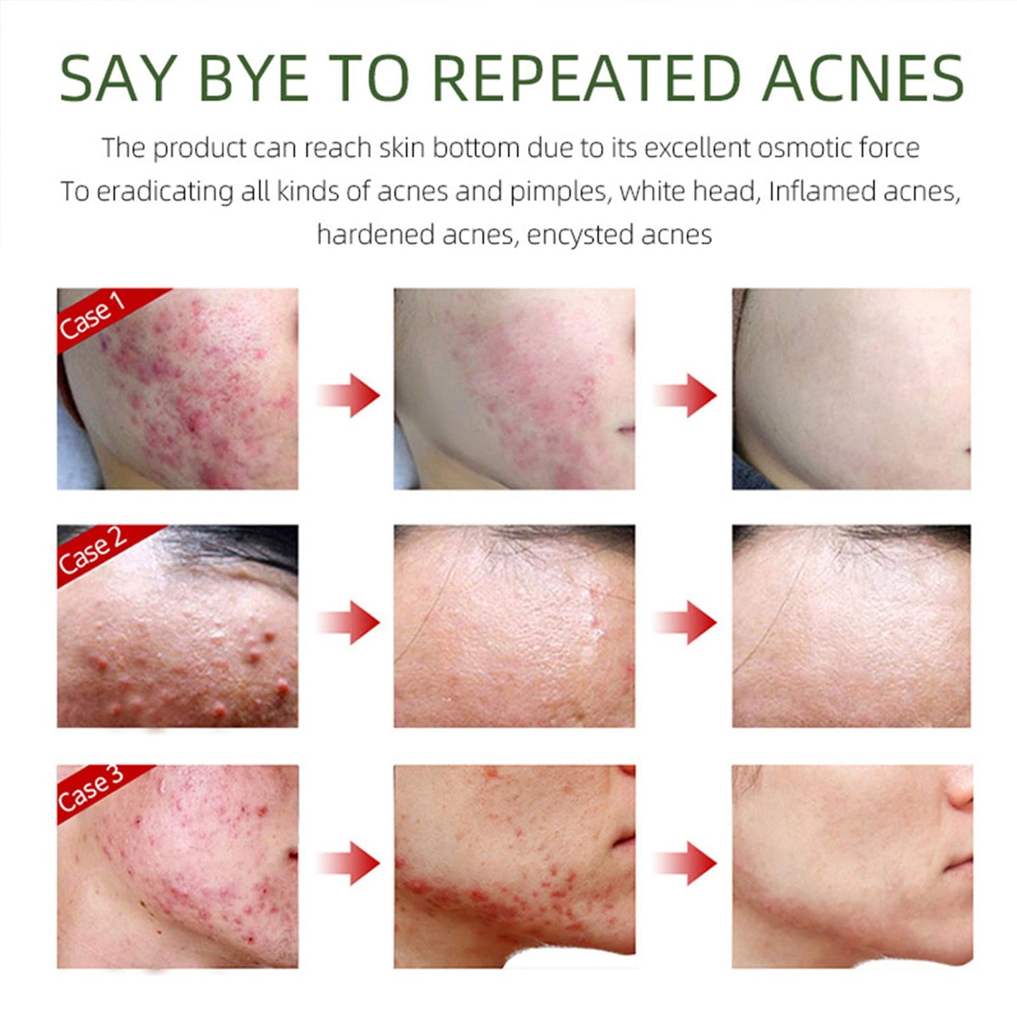 QEUTKEZS Herbal Acne Removing Cream,Professionally Remove Acne Marks,Gently Moisturize,Refreshing & Not Greasy,Improving Sensitive Skin Prone to Acne,Acne Scar Cream & Pimple Remover For All Skin Types