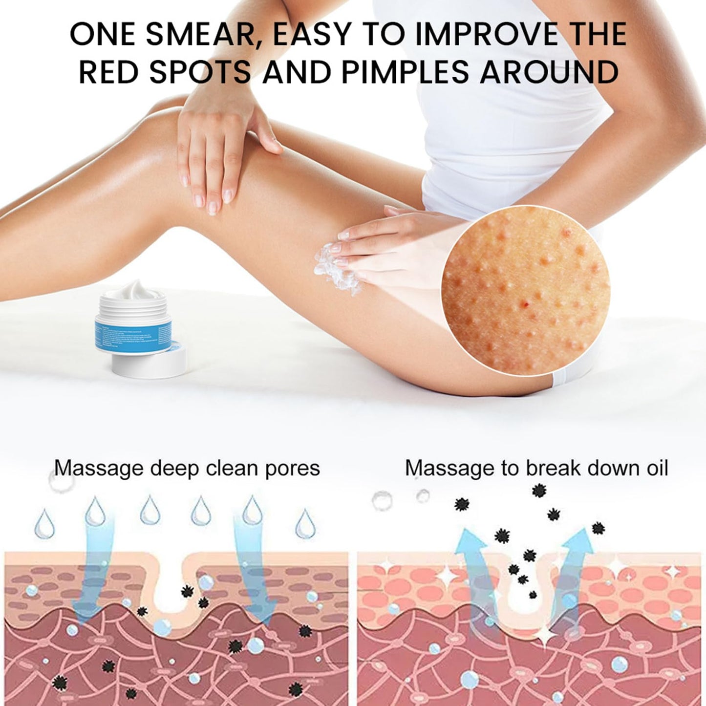 Strawberry Legs Treatment Body Cream,Keratosis Pilaris Cream Treatment with Vitamin E and Urea,Skin Exfoliating Repair Cream for Chicken Skin Treatment,Eliminates Strawberry Spots(30G)