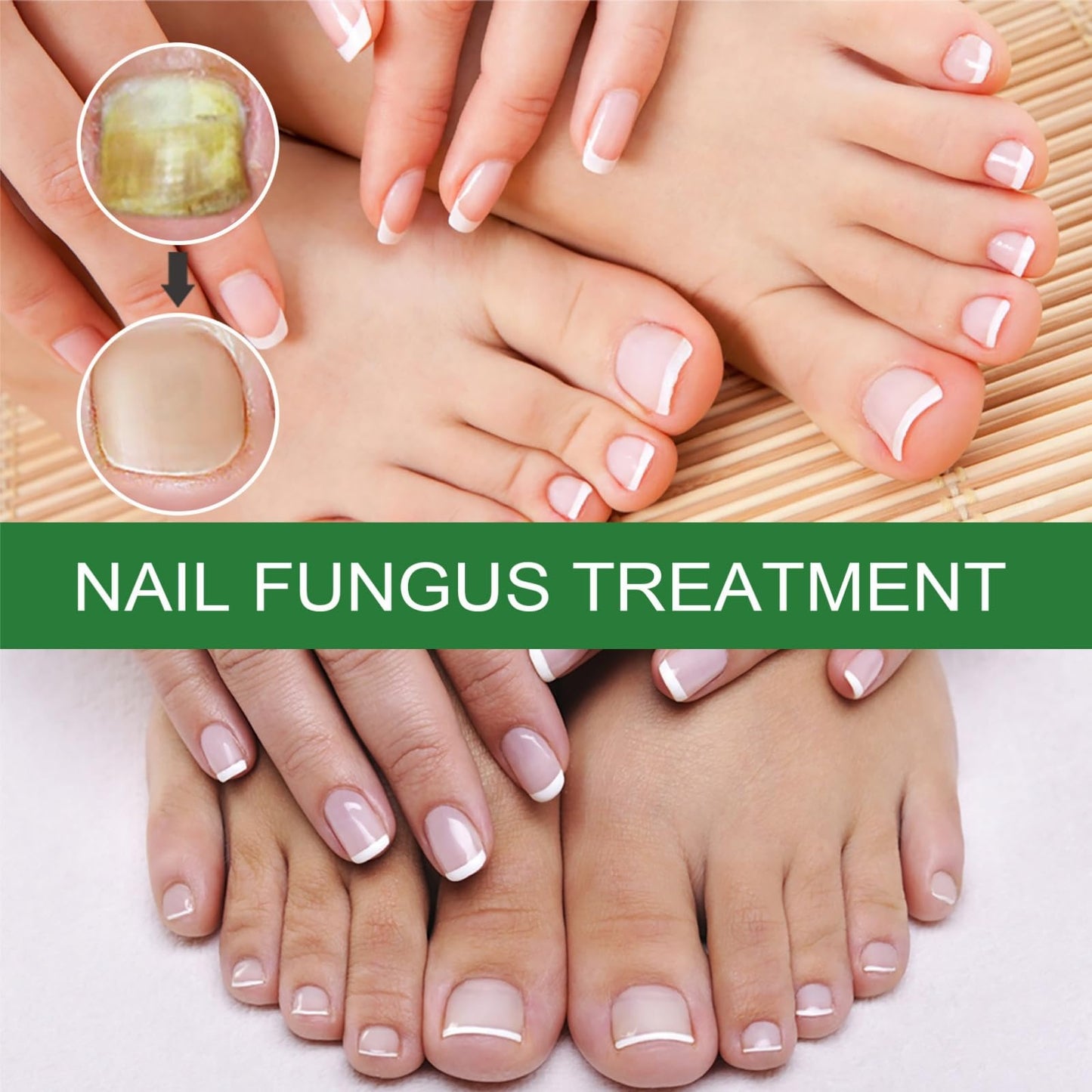 7 Days Nail Fungus Treatment,Ginger Nail Treatment,Fungal Nail Treatment,Toenail Fungus Treatment Extra Strength,Fungal Nail Treatment for Toenails Extra Strong,Nail Repair,Nail Growth Serum,50ml