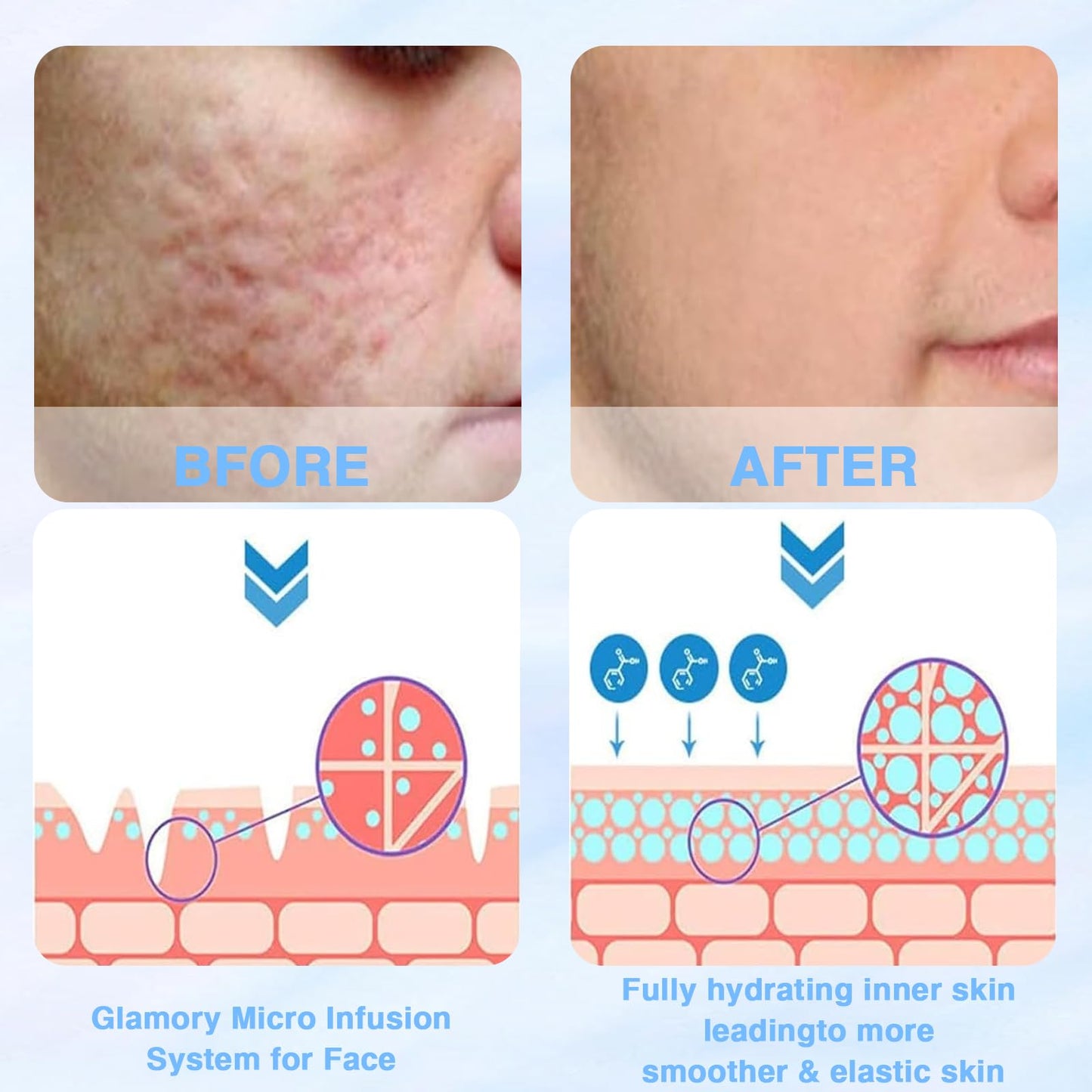 Bettinay 5PCS Micro Infusion Facial System for Lips, Serum Beauty Kit for Repair Skin Deep Nourishment All Skin Types