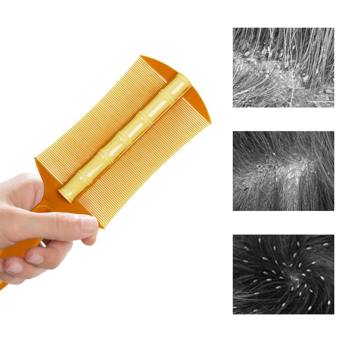 Generic 2Pcs Dandruff Comb Lice combs Psoriasis comb Fine tooth comb Dandruff comb remover Removal Fleas,Lice,Dandruff and Tangled Hair