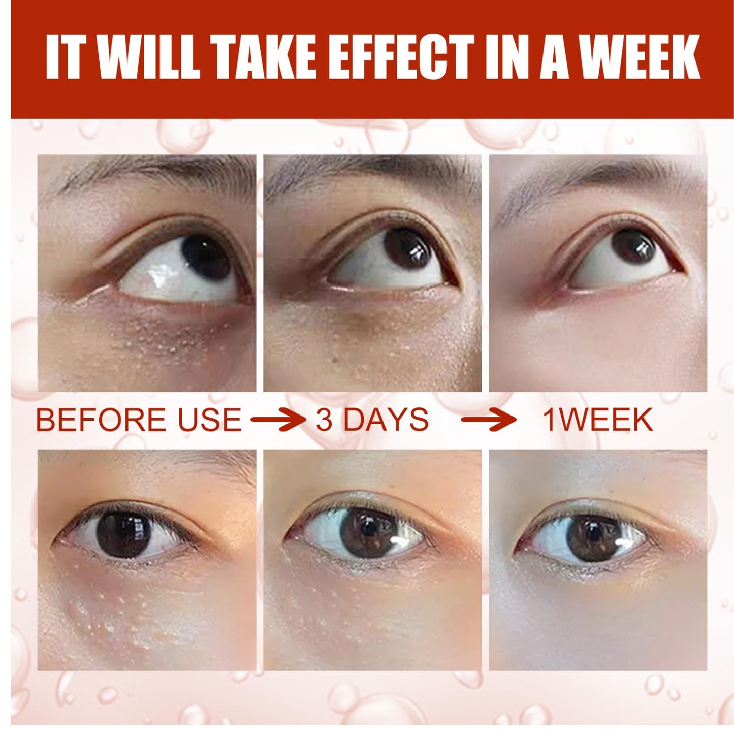IZBEAUVO 2PCS Milia Remover Serum, Milia Remover for Face Fast-Acting Milia Spot Remover, Anti-Aging Eye Serum for Dark Circles and Puffiness, Reduces Wrinkles Saggy Skin & Puffy Eyes