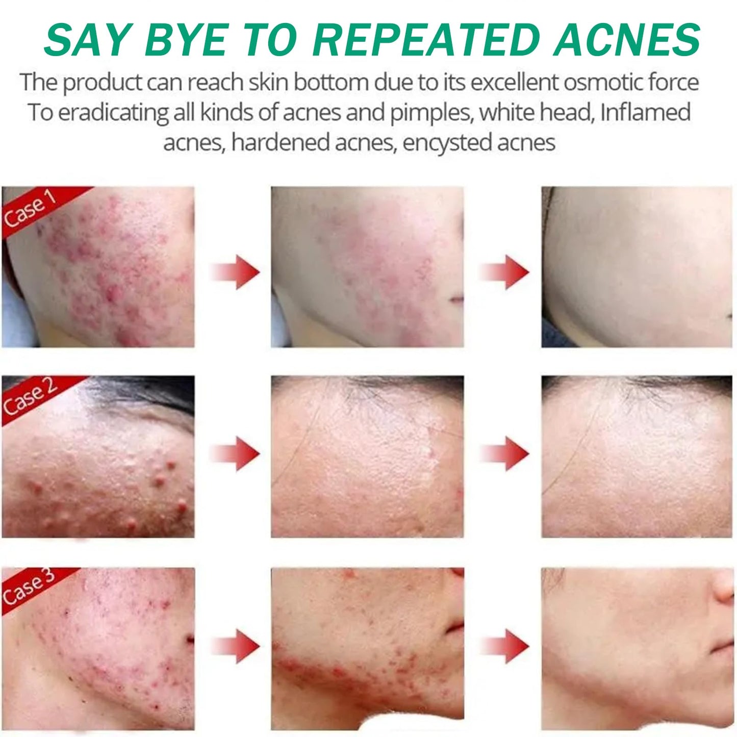 Anti Acne Face Cream, Spot Cream for Acne Treatment and Spot Treatment with Nicotinamide, Sodium Hyaluronate, Aloe, for Blackheads and Acne Prone Skin, Reduces Spot Size, Redness and Inflammation