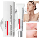 Oumun 15% Acid Acne Treatment Gel,Anti Acne Face Cream,Face Acne Treatment,Acid 15% Facial Serum Cream,Spot Treatment,Gentle Acne Cream,Spot Serum Cream for Face,Pimple Treatment Gel Cream,Face Gel for Acne