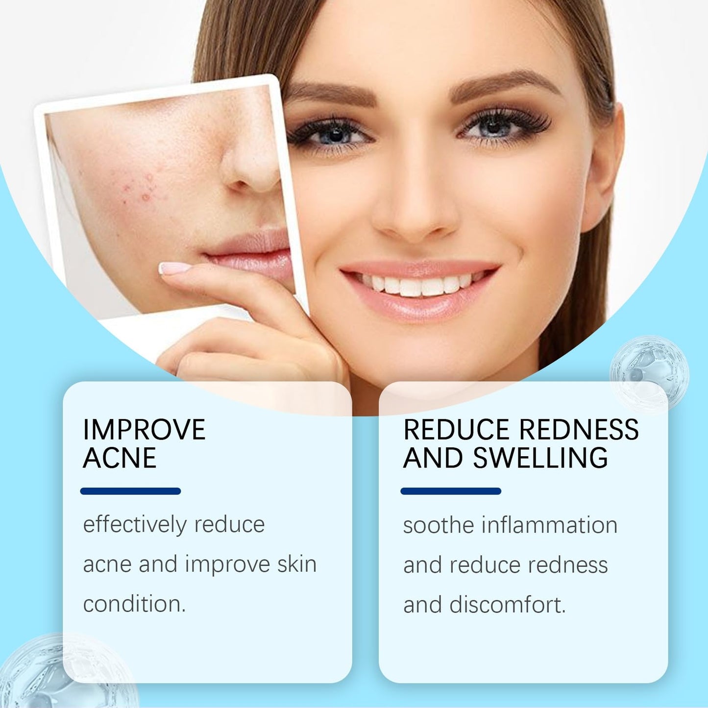 Acne Control Cream for Face,Face Serum for Acne Treatment,Acne Gel Fast Absorbing Spot Treatment,Fast Acting Spot Treat/ment for Fa/ce,Fungal Acn/e Treatm/ent for Women,Gel for Sp/ot Prone Skin