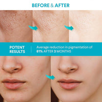 TBeautfave 2PCS Dark Spot Remover for Face, Dark Spot Corrector | Dark Spot Corrector Serum | Advanced Formula with Vitamin C & Hyaluronic Acid | Fades Dark Spots, Evens Skin Tone & Reduces Hyperpigmentation