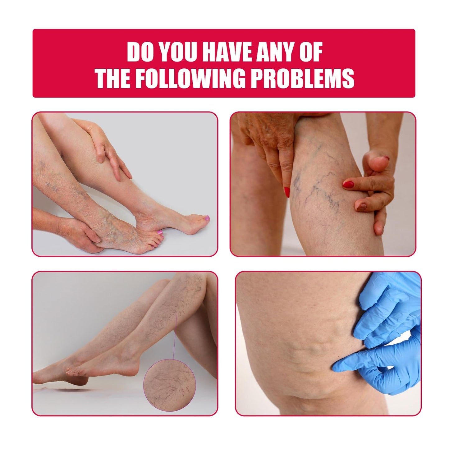 Varic/ose Ve/ins Treatment for Legs,Natural Varic/ose Ve/ins Cream,Varic/ose Ve/ins Treatment Cream,Cream for Varic/ose Ve/ins in Legs,SPI/der V/eins Repair Cream,Varic/ose Ve/ins Relief Cream