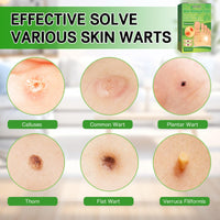 Soneat Wart Remover, 30pcs Verruca Treatment, Plantar Wart Remover for Hands, Feet, Effective Deep Verruca Removal Pads Patches, Pain Relief, Non-irritating Wart Treatment for Adults