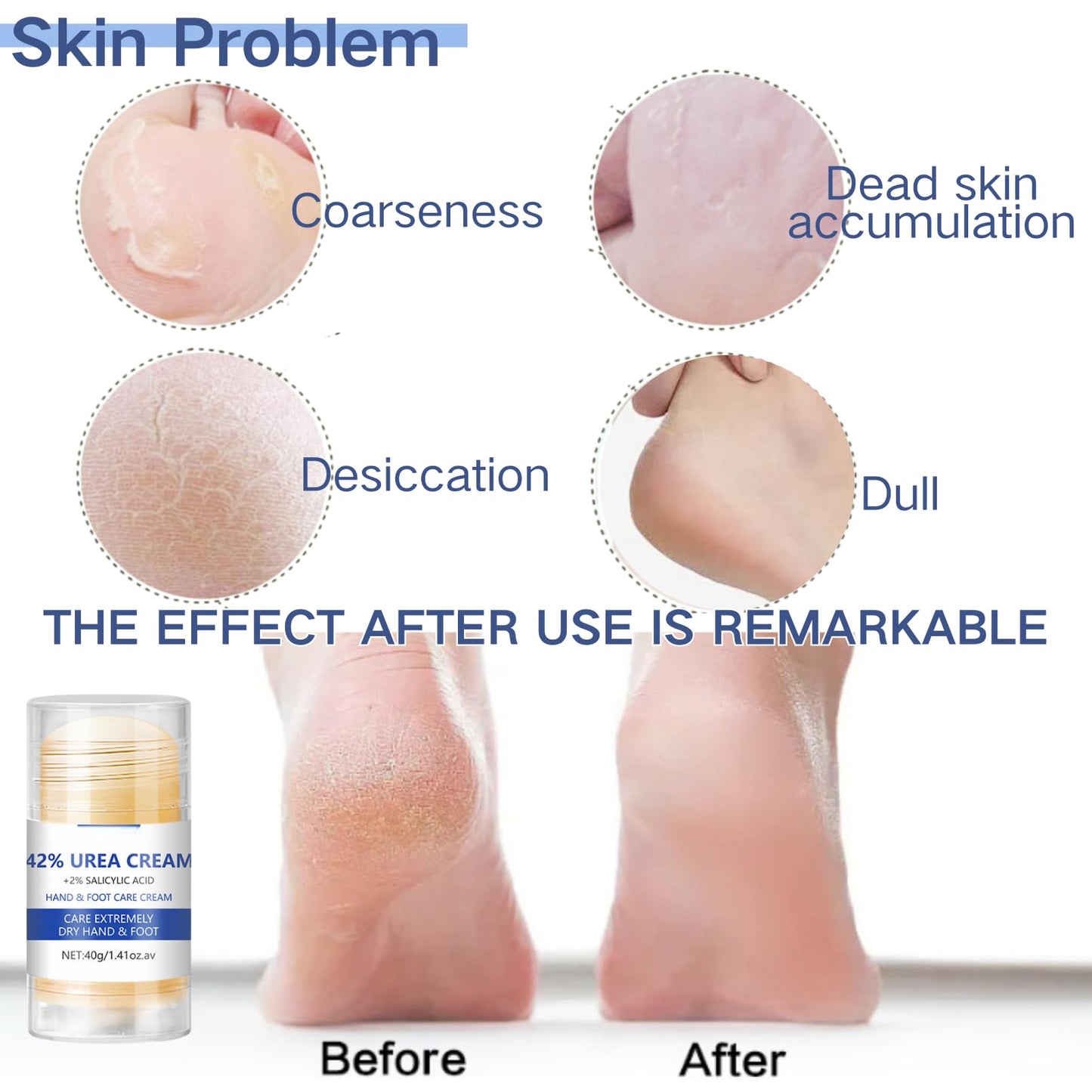 Urea Foot Cream - Urea Cream - Foot Cream 42 Percent for Cracked And Dry Skin - Foot Moisturiser Repair Cream Skin Care Hands & Feet - Heel Balm for Cracked Heel