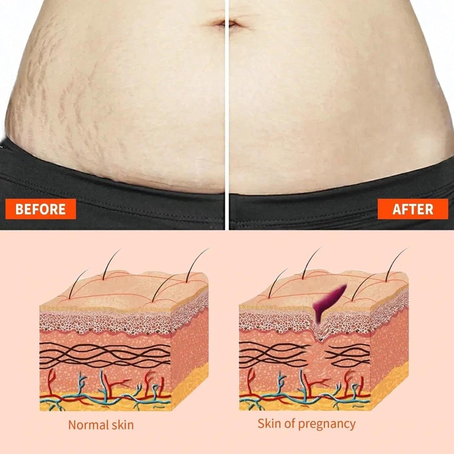 Natrcollor 2 PCS Stretch-Mark Scar Treatment Oil, Collagen Boosting Firming & Lifting Skincare for Women. Helps Remove Stretch Marks & Scars, 250 ml