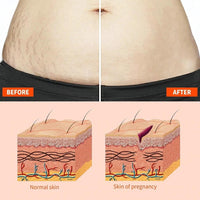 Natrcollor 2 PCS Stretch-Mark Scar Treatment Oil, Collagen Boosting Firming & Lifting Skincare for Women. Helps Remove Stretch Marks & Scars, 250 ml