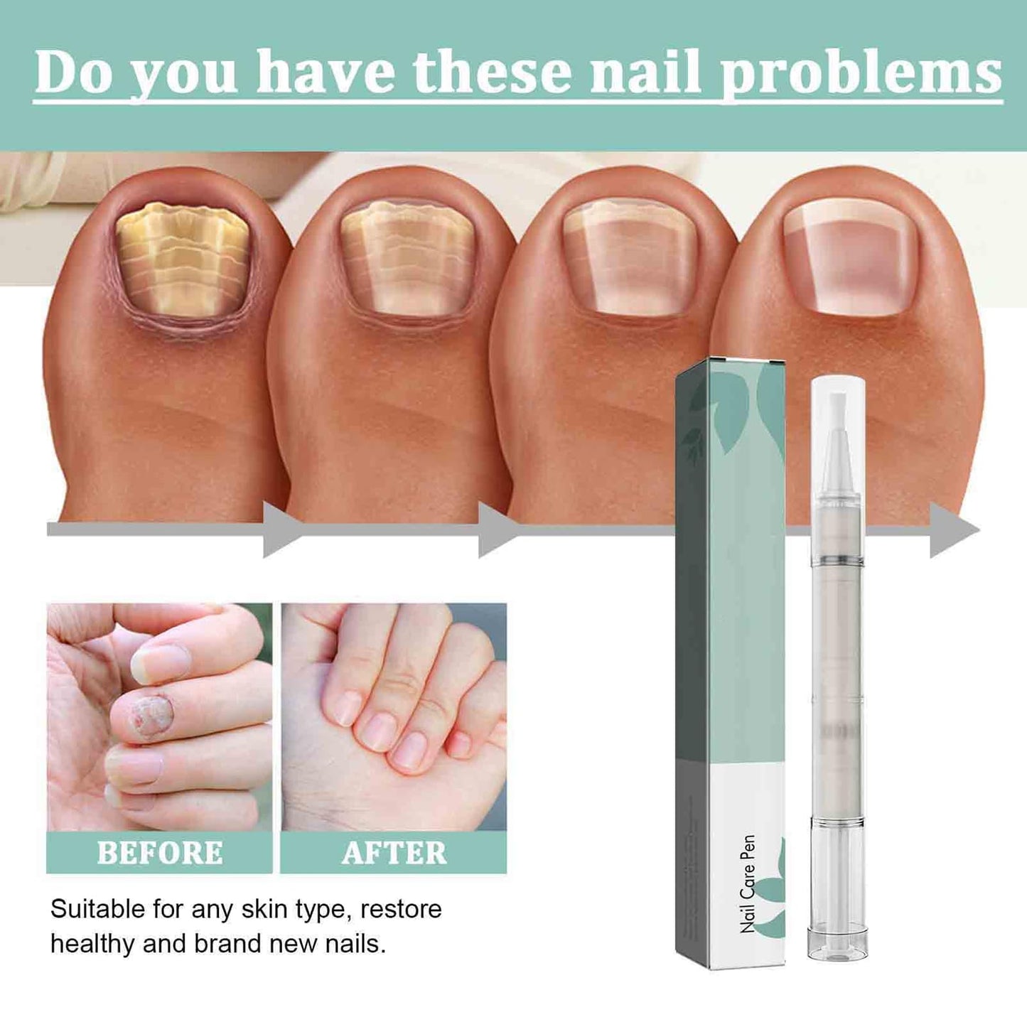 Nail Care Pens, 5Pcs Fungal Nail Treatment Pens, Fungal Nail Treatment for Toenails, Nail Repair Pen, Natural Ingredients Nail Serum for Strengthener Nail