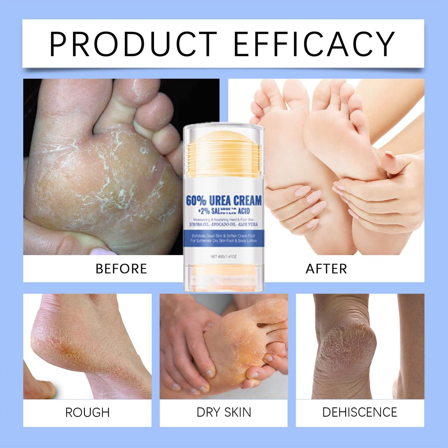 DMQ Urea Foot Cream 60 Percent - Cracked Heel Repair Cream - 60% Urea Cream for Cracked Heels and Dry Skin - Feet Hard Skin Remover - Moisturizing Hands and Foot Skin Care
