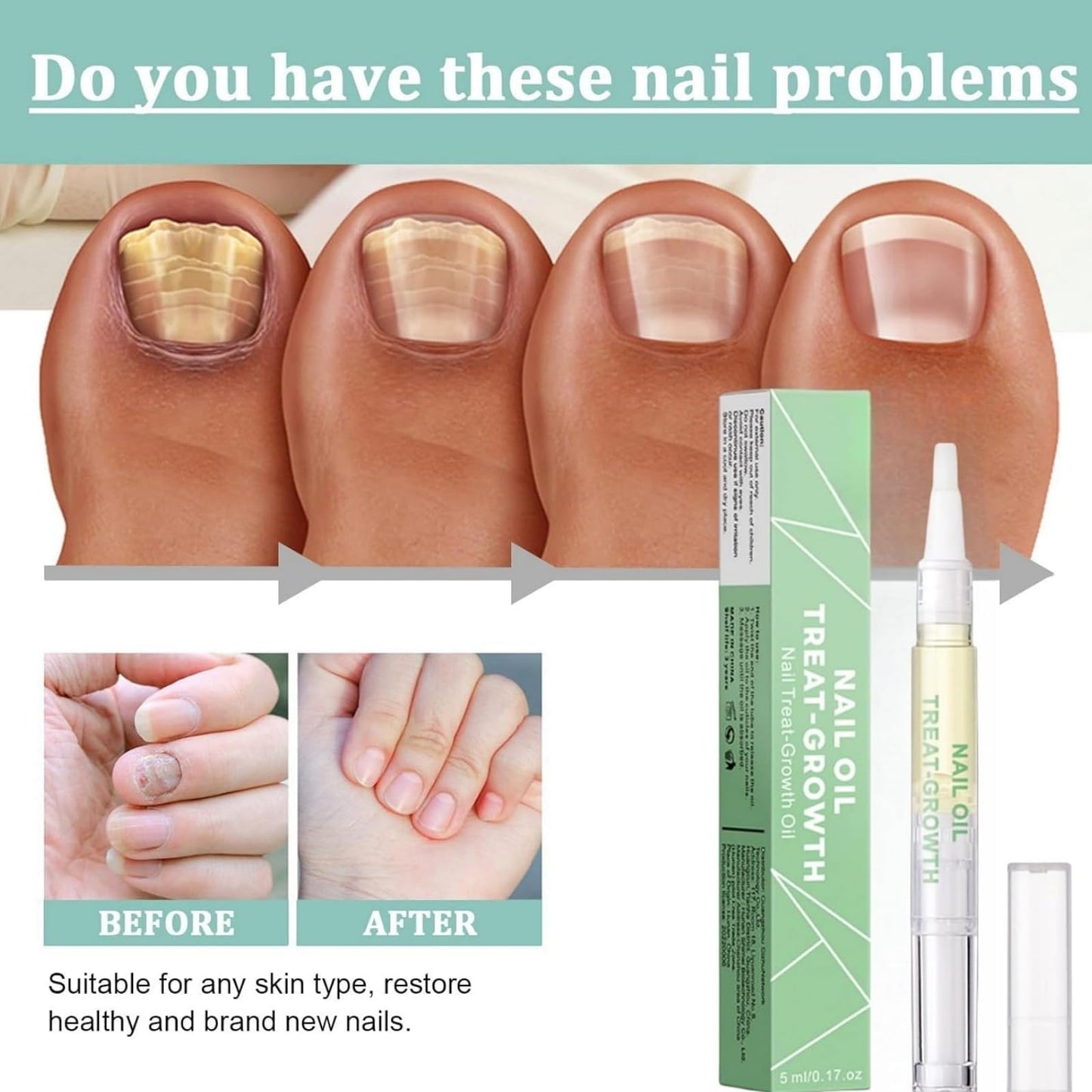 2pcs Radiant Nail Growth Oil,Cuticle Moisturizer & Nail Strengthener with Vitamin E Cuticle N/ail Oi/l,Radiant N/ail Growth O-il Pen,Cuti-cle Oi/l Pen for Nails,Nail-Oil Treatment for Damaged Na-ils