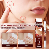 Wart Remover Pen,Mole and Wart Removal Pen,Dark Spots Treatments Mole Wa/rt Remover for Face,Liquid Pe/n Stops Regrowth Skin Care,Easy Removal P/en,Wa/rt Remov/ers for Sk/in Type,Verruca Treatments