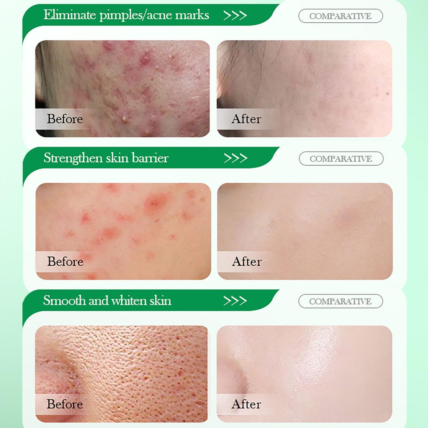 ISBEAUSOLS Salicylic Acid Acne Cream 50g - 3% BHA Spot Cream for Acne - Blackhead Remover - Dark Spot Remover for Face - Scar Removal Cream - Moisturizing Face Cream for Women - Pimple Cream for Redness