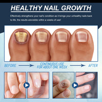 Nail Strengthener, 2PCS Revitalizing Nail Growth Serum, Nail Hardener Extra Strong and Growth - Nail Repair Serum for Damaged Nails for Faster Growth - Achieve Stronger, Healthier Nails