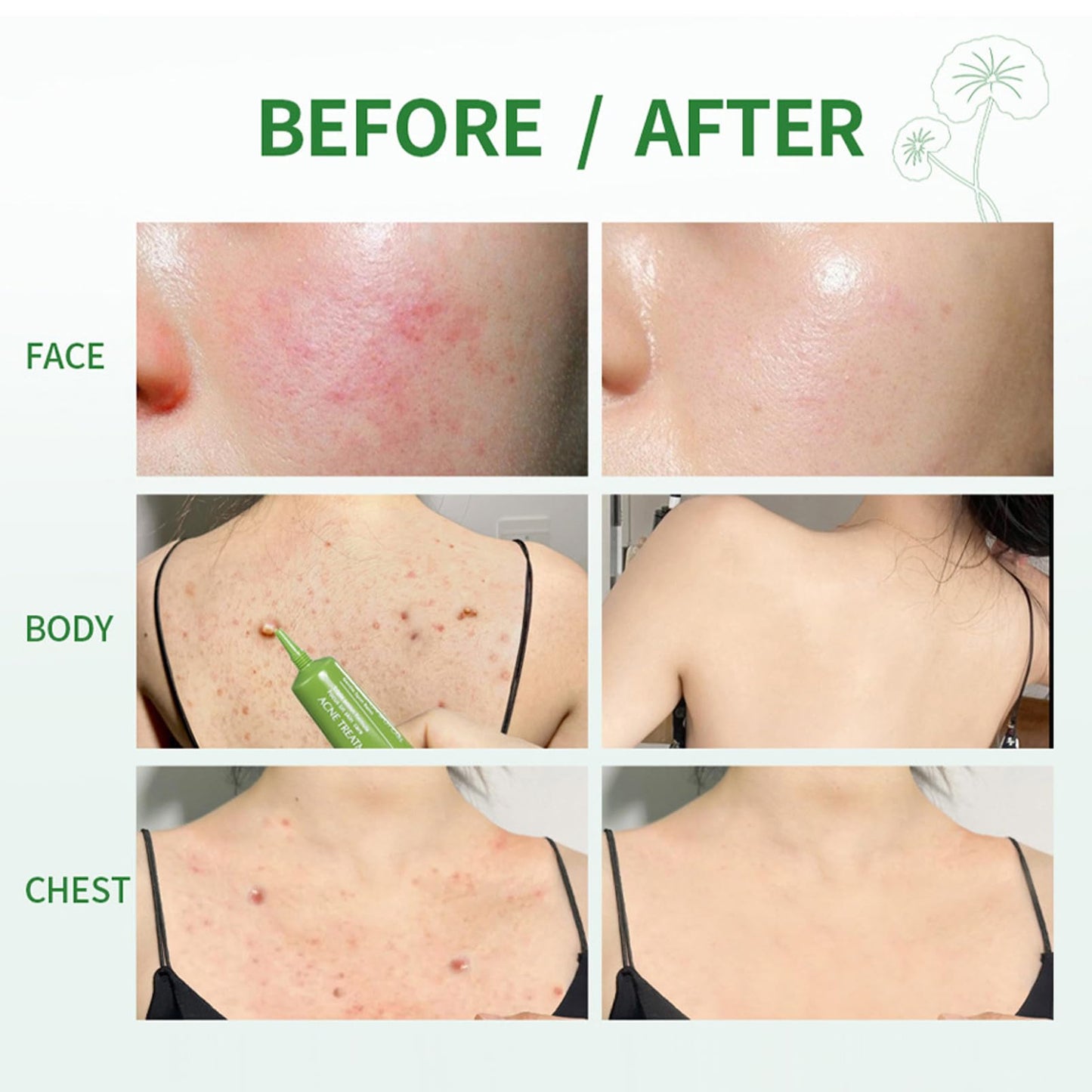 Anti Acne Face Cream, 3X Centella Face Ance Gel, Spot Cream for Acne Treatment and Spot Treatment Shrink Pores, Acne Scars Recovery, Control Sebum Secretion, Relieves Redness &Anti-Bacterial