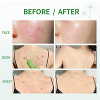 Anti Acne Face Cream, 3X Centella Face Ance Gel, Spot Cream for Acne Treatment and Spot Treatment Shrink Pores, Acne Scars Recovery, Control Sebum Secretion, Relieves Redness &Anti-Bacterial