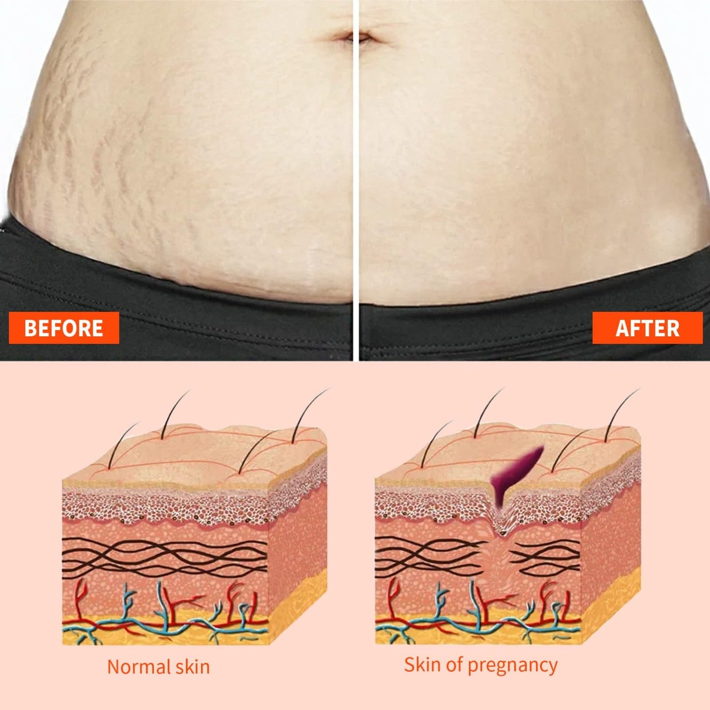 Stretch Mark Treatment Oil for Women - Optimal Formula for Removal of Stretch Marks, Scars, Firming & Lifting Body Care, 50ml