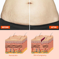 Stretch Mark Treatment Oil for Women - Optimal Formula for Removal of Stretch Marks, Scars, Firming & Lifting Body Care, 50ml