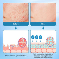 Leogony 5 PCS Serum Micro Infusion Facial System with Roller, Micro Infusion Facial System for Lips for Repair Skin Deep Nourishmen