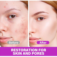 MEITREND Acid 12% Facial Serum,2PCS Rosacea Treatment for Face,Anti Acne Cream for Women & Men,Anti Redness Cream for Face,Reduce Acne & Removes Redness,Skin Care Gel