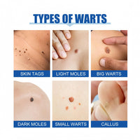 Xunzhi 24pcs Wart Treatment Patch,Corn Remover Pads,Verruca Treatment Corn Plasters,Foot C/ORN Remover Patch C/ORN,Wart R/emover,Co/rn Callus R/emover,Pain Relief W/Art Plaster,Co/rn Plasters for Toes