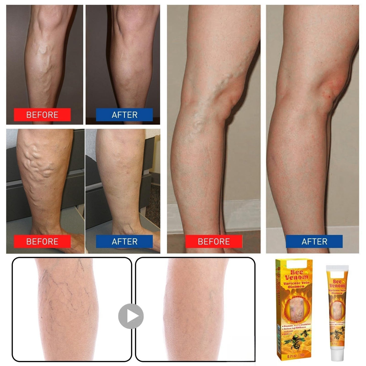 Varic/ose Ve/ins Treatment for Legs,Natural Varic/ose Ve/ins Cream,Varic/ose Ve/ins Treatment Cream,Cream for Varic/ose Ve/ins in Legs,SPI/der V/eins Repair Cream,Varic/ose Ve/ins Relief Cream