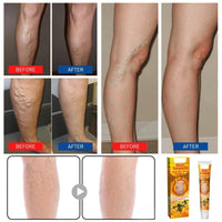 Varic/ose Ve/ins Treatment for Legs,Natural Varic/ose Ve/ins Cream,Varic/ose Ve/ins Treatment Cream,Cream for Varic/ose Ve/ins in Legs,SPI/der V/eins Repair Cream,Varic/ose Ve/ins Relief Cream