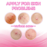 Xunzhi Acne Cream Pimple Cream for Face,Acne Treatment,Oil Control Pimple Remover Cr/eam,S/p/o/t Treatment,S/p/ot Crea/m,Acn/e Scar Treatm/ent,Anti Redness Crea/m for Face,Pim/ple Cre/am S/p/o/t Treatm/ent