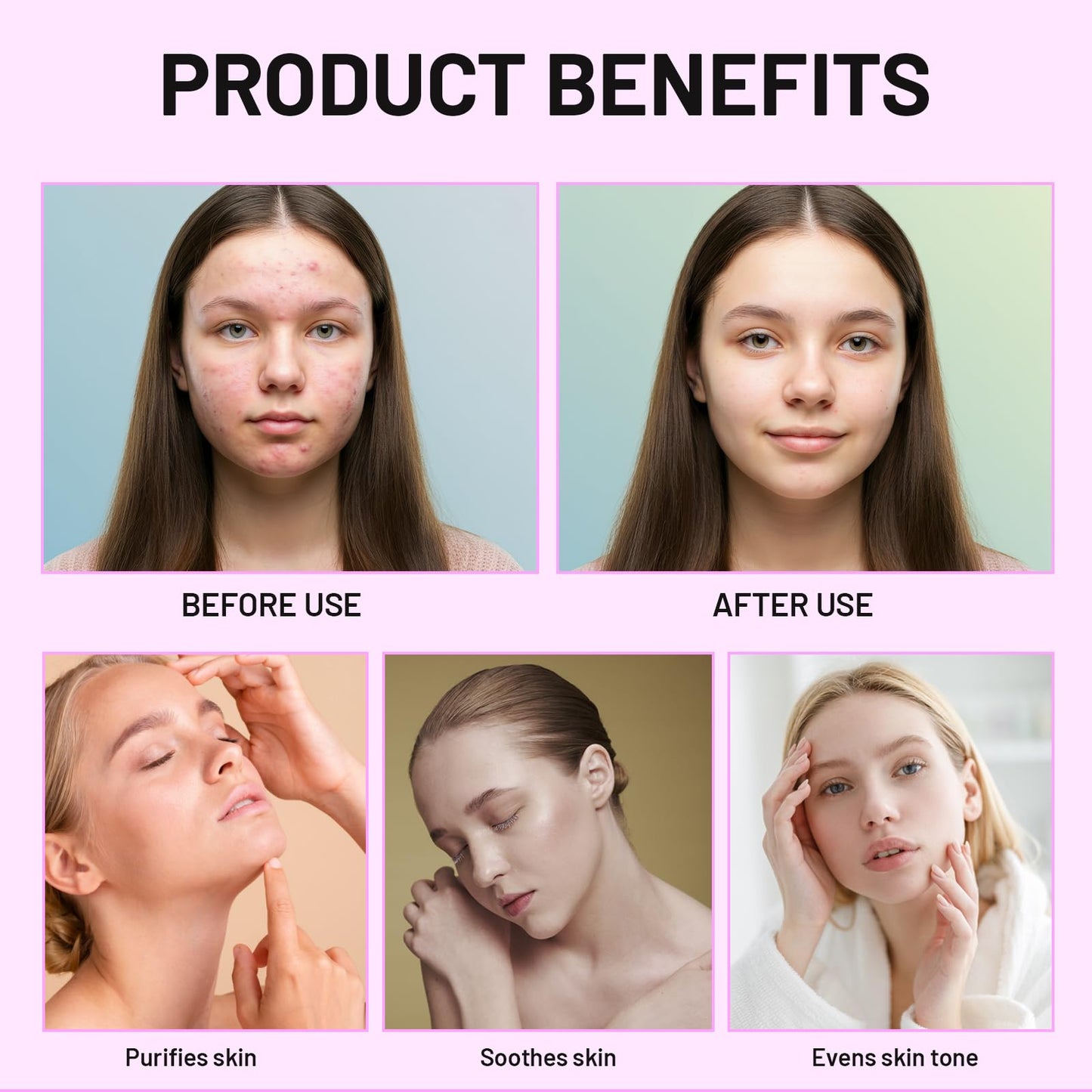 Bettinay Rosacea Cream for Face, 12% Azelaic Acid Cream, Gentle and Moisturizing for all Skin Pigmentation Redness