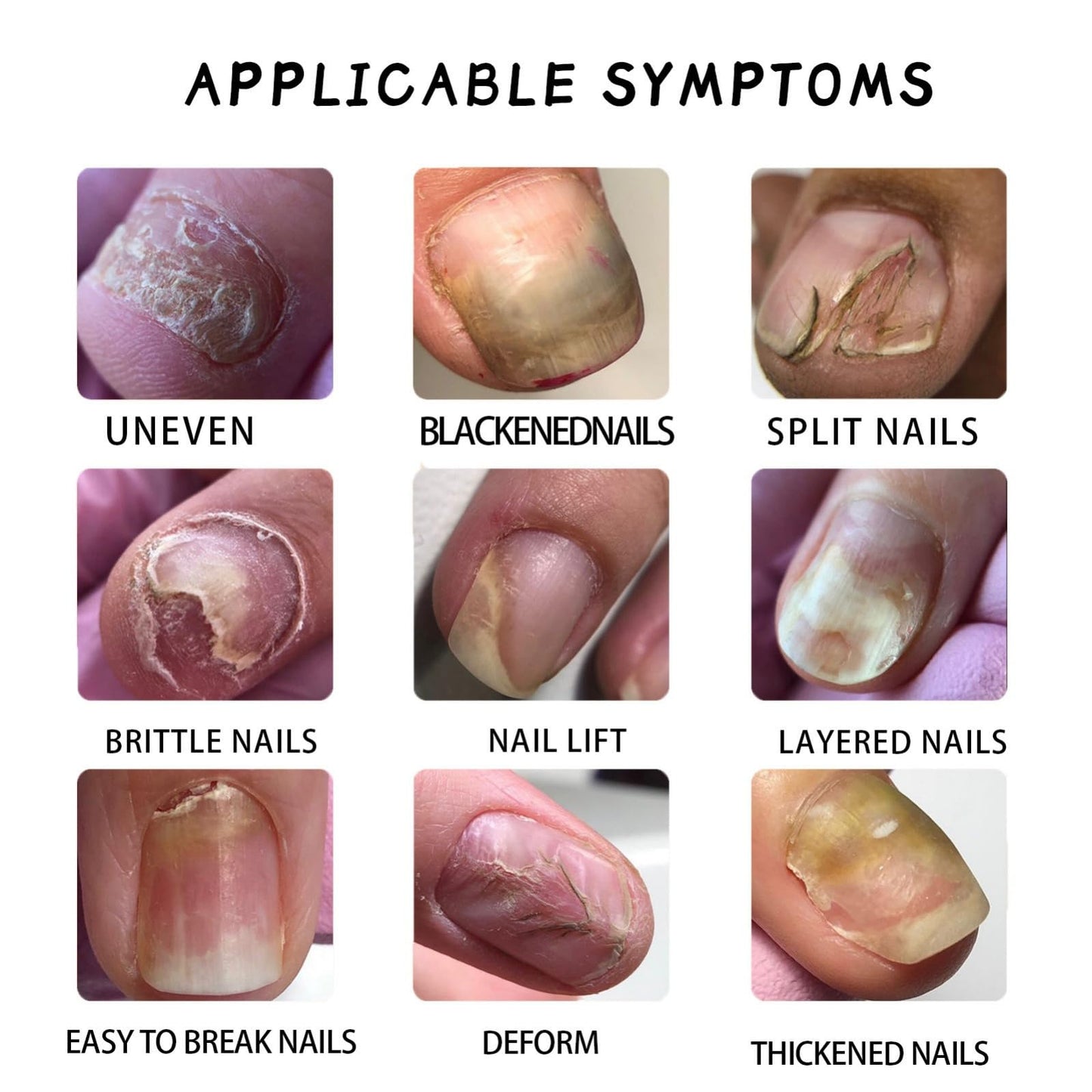 7 Days Nail Fungus Treatment,Ginger Nail Treatment,Fungal Nail Treatment,Toenail Fungus Treatment Extra Strength,Fungal Nail Treatment for Toenails Extra Strong,Nail Repair,Nail Growth Serum,50ml