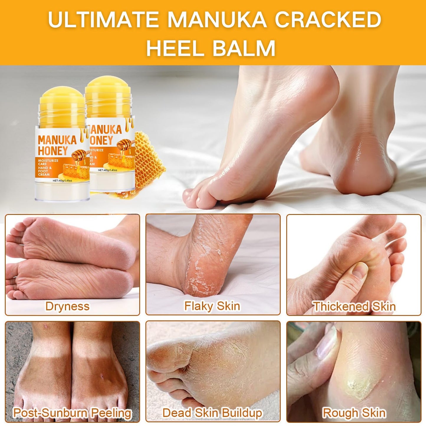 Tongyend 2PCS Urea Cream 60 Percent for Feet & Hands – Honey & Urea Foot Cream, Intensive Foot Moisturiser, Cracked Heel Repair Cream for Dry Skin & Hard Calluses (Orange, 2PC)