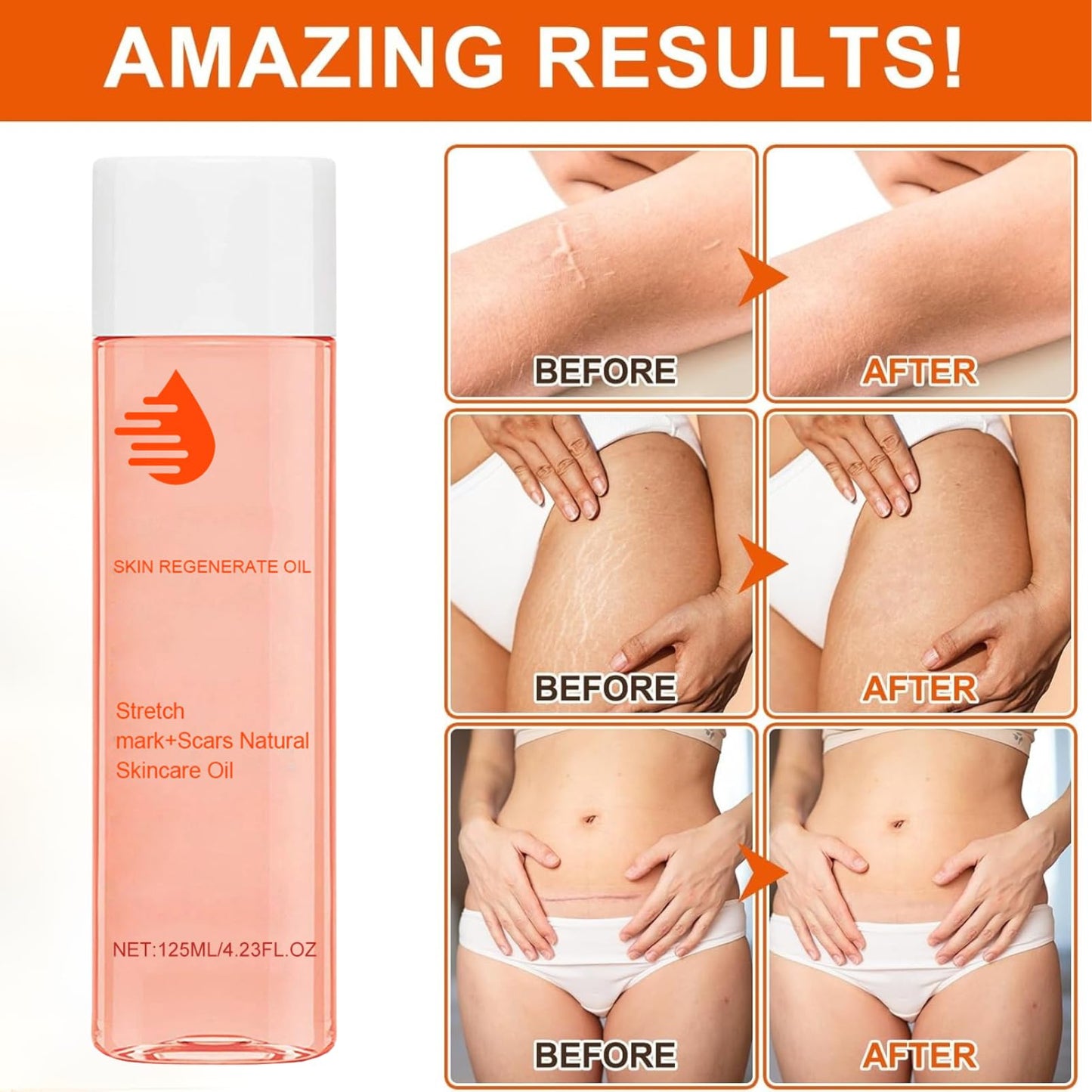 IZBEAUVO 125ml Scar Treatment Oil, Natural Stretch Mark & Scar Skincare oil, Stretch Marks Removal Body Oil for Women, Boost Collagen for Firming and Lifting Improve the Appearance of scars & Skin Tone