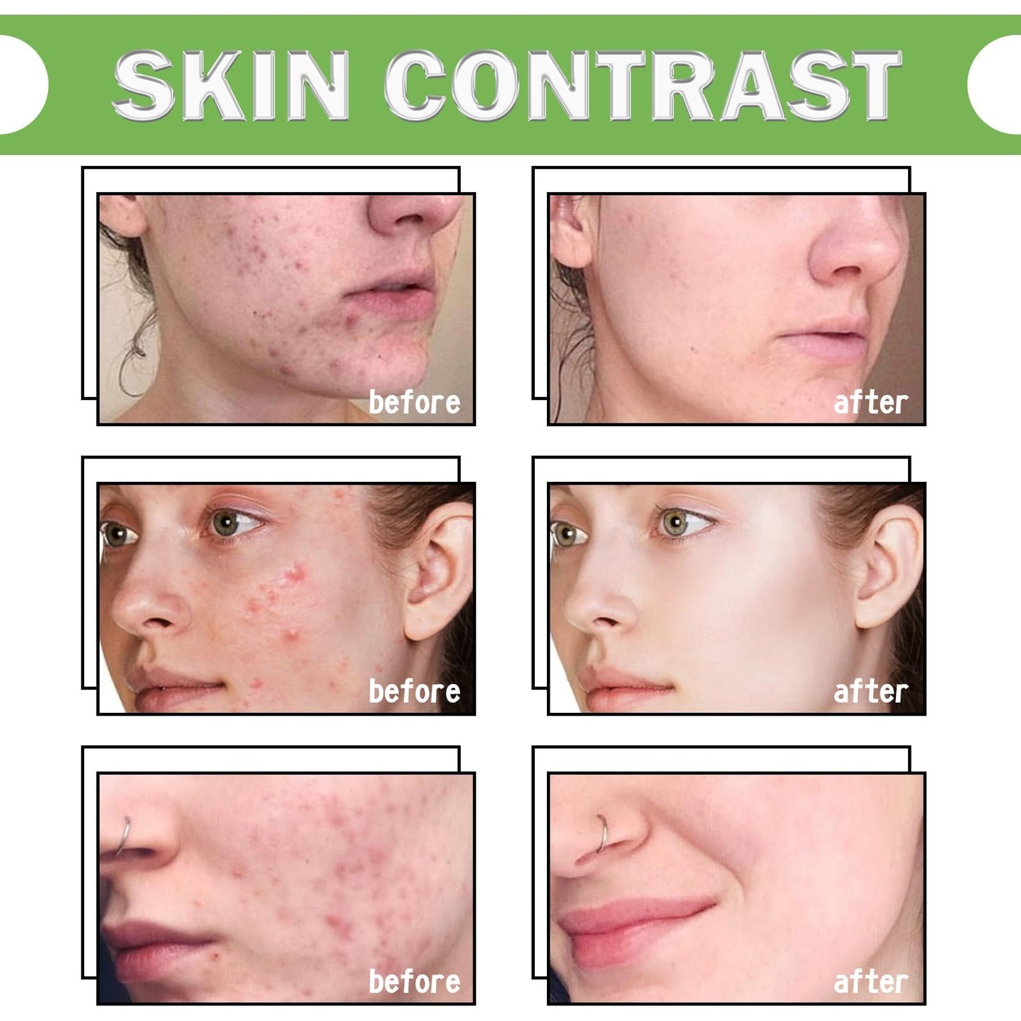 Jinjiar Aze-laic Ac-id 10% Facial Serum,Aze-laic Ac-id Cream for Face,Face Serum for Women,Az-elaic Aci-d Cream Gel,Hydrating Face Cream,Night Moisturiser,Face Cre-am,Night Cr-eam,Fa-ce Care,Skinoren Cre-am