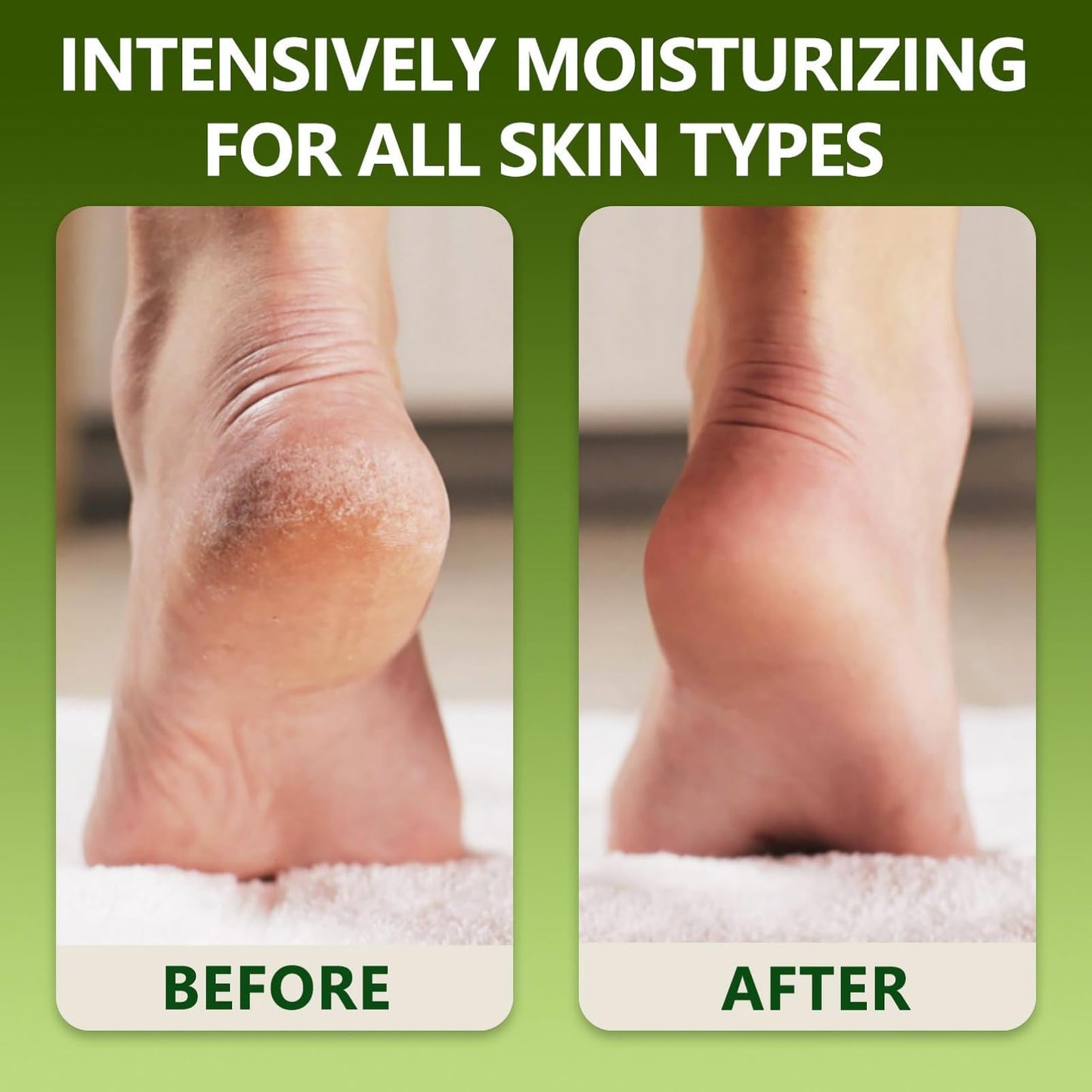 IZBEAUVO Tea Tree Oil Foot Cream 150ML, Foot Cream For Very Dry Feet, Cracked Heel Repair Cream, Tea Tree Cream, Intensive Moisturizer Heel Balm For Cracked Heel,Softens Feet&Hand&Knee