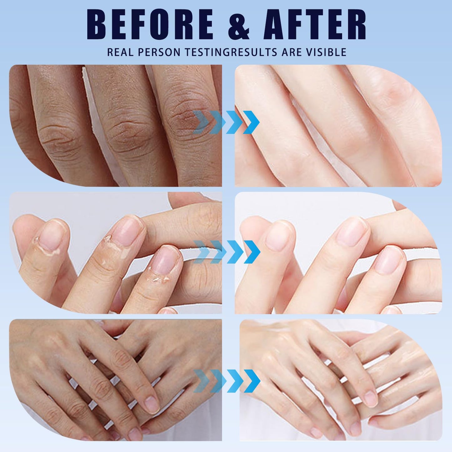 2-Pack-Urea Cream for Cracked Heels & Dry Skin – Intensive Foot Moisturiser & Hand Cream – Improve & Hydrate Rough Skin