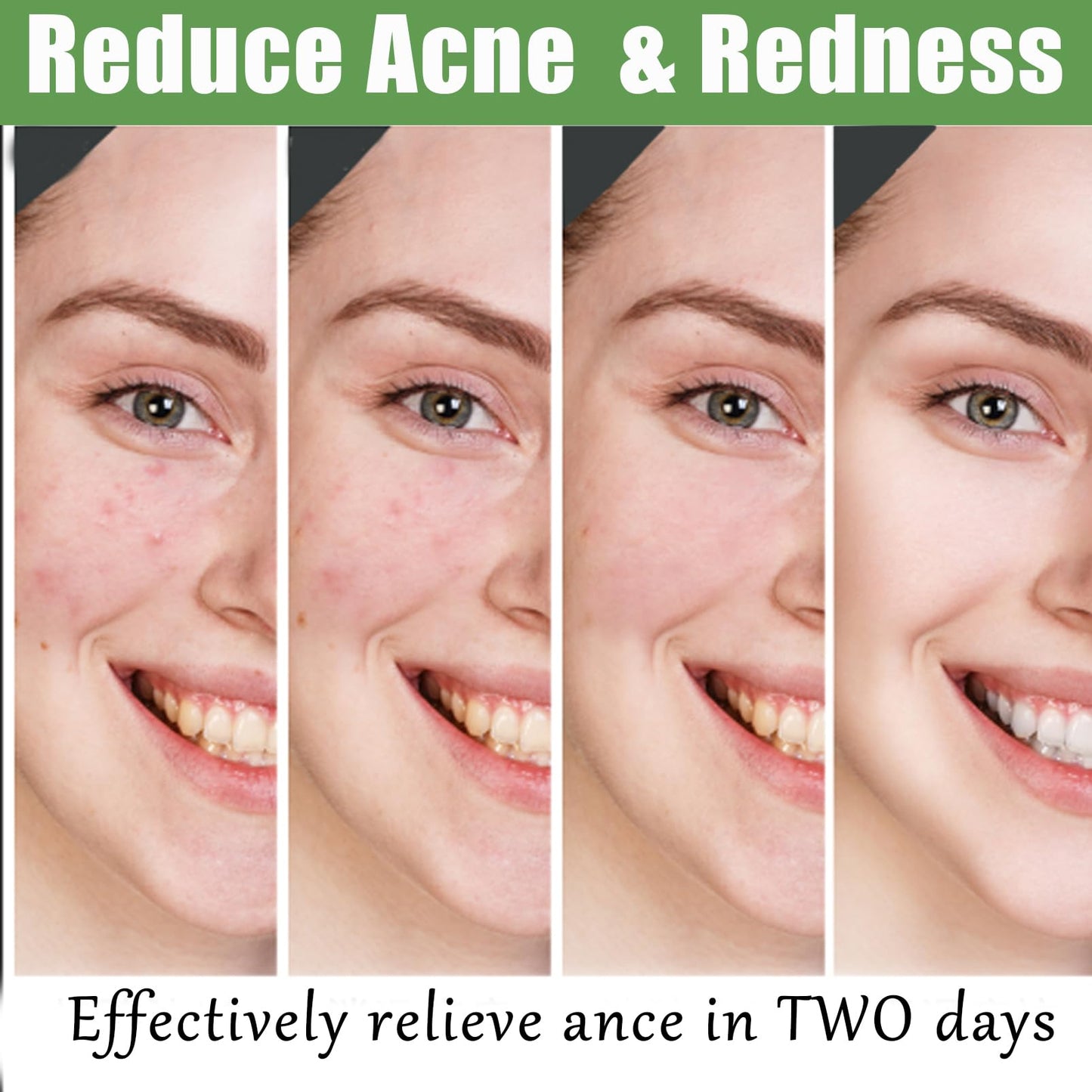 Anti Acne Face Cream,Gentle Acne Cream for Acne Prone Skin,Anti Acne Removal Cream with Plant Extract,Moisturiser Face Cream for Acne Mark,Fade Acne Mark & Calm Acne Redness,Scar Removal Cream