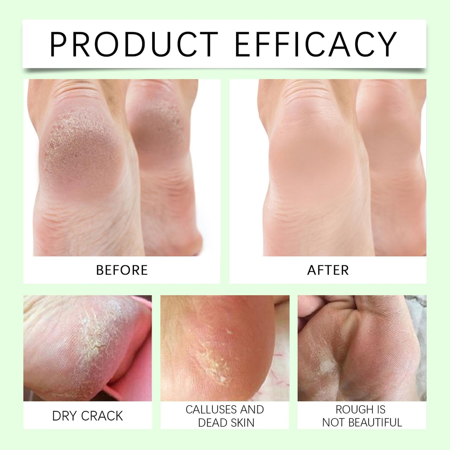 DMQ Urea Cream 40% for Feet Plus 2% Acid, Urea Foot Cream, Tea Tree and Aloe Vera for Deep Moisture - Foot Cream for Cracked Heels and Dry Skin, Cracked Heel Repair Cream Skin Care for Hands & Feet