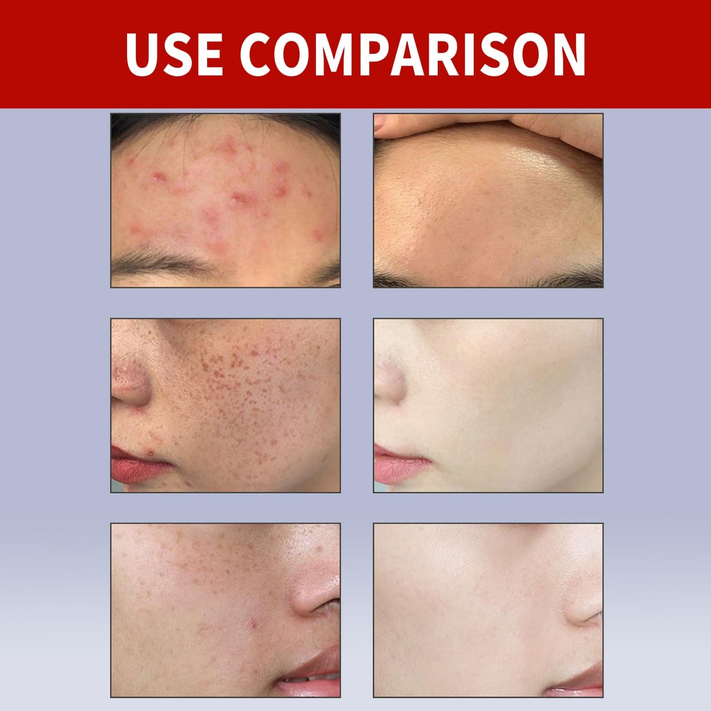 ISBEAUSOLS Freckle Removal Cream - Dark Spot Removal Cream with Niacinamide & Vitamin C - Dark Spot Re-mover for Face - Spot C-ream for Women - Melasma C-ream - Improve Skin Dullness, Fade S-pots Blemishes