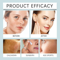 SingHao Dark Spot Remover for Face&Body,Dark Spot Correcting Cream,Dar/k Sp/ot Remover,Pigmentation Removal,Da/rk Spo/t Corrector Cream,Freckle Removel Crea/m,Hyperpigmentation Treatment Mela-Sma Cr/eam